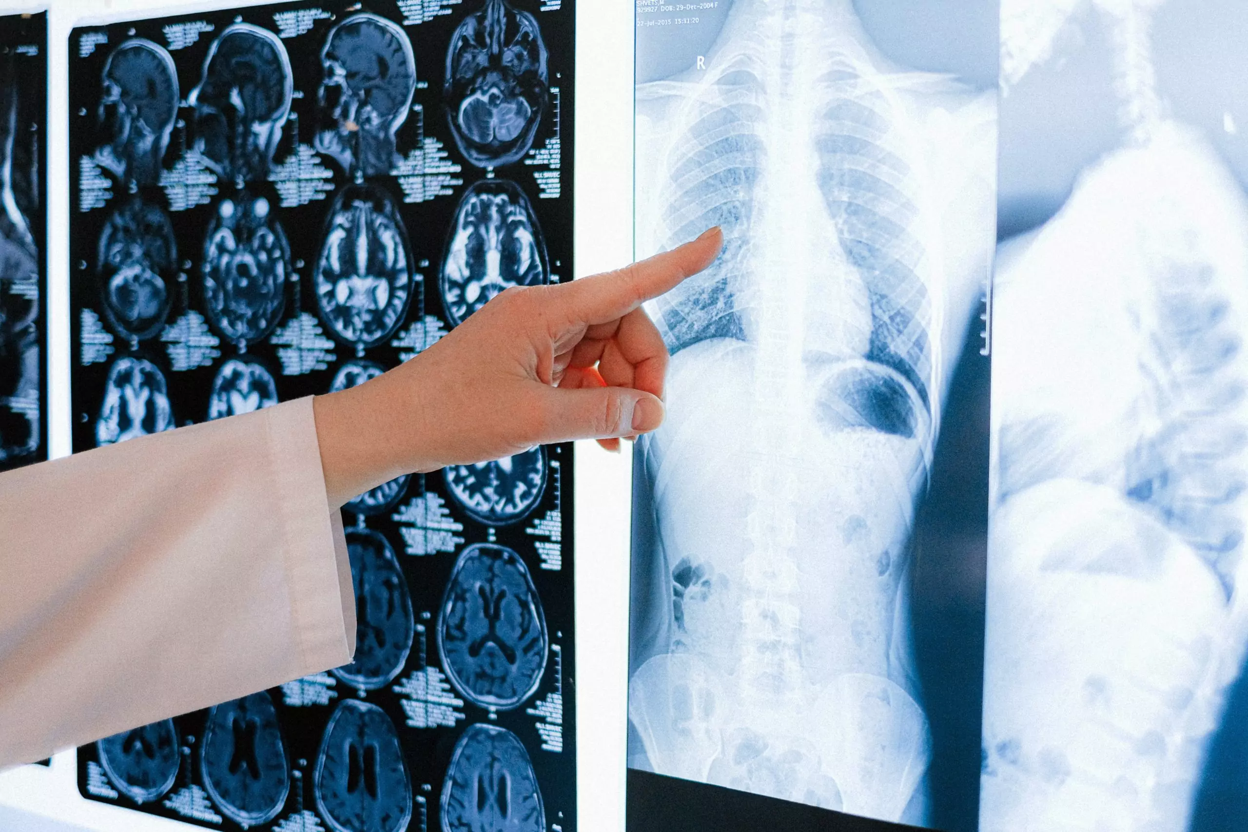 ARRIVA IL FARMACO CHE BLOCCA IL TUMORE AL POLMONE