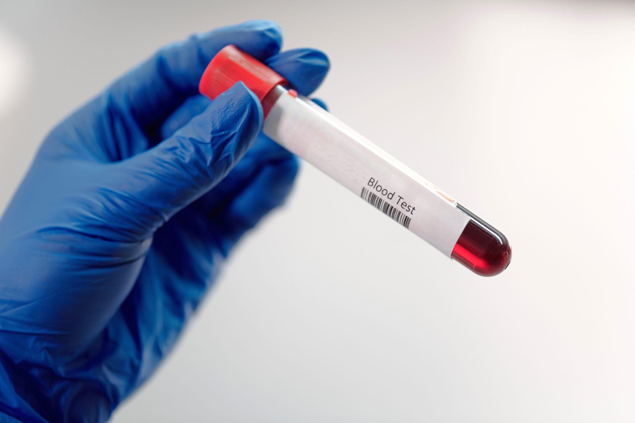 ARRIVA L'ESAME DEL SANGUE PER PREVENIRE L'ALZHEIMER
