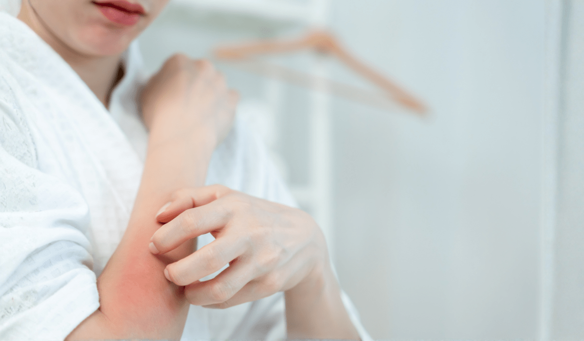 APPROVATO IL PRIMO FARMACO NON ANTISTAMINICO PER LA CURA DELL'ORTICARIA CRONICA